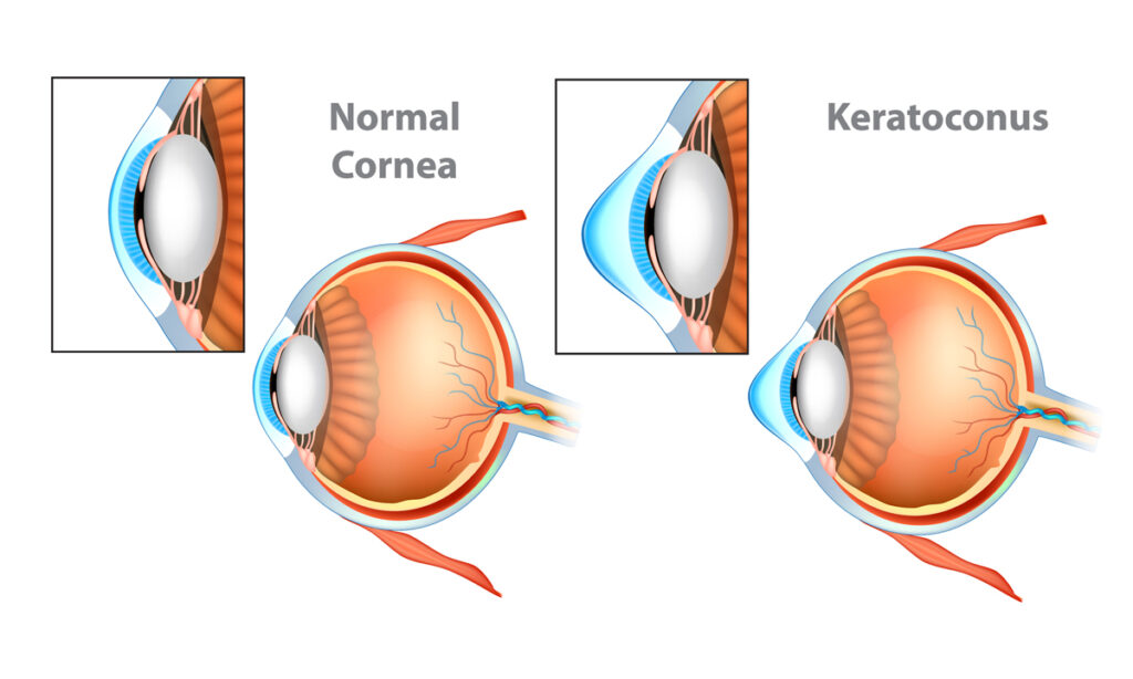 Keratoconus 